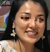 爸妈过年给你养的肥肉，可以用自体脂肪填充术解决330