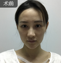 爸妈过年给你养的肥肉，可以用自体脂肪填充术解决330