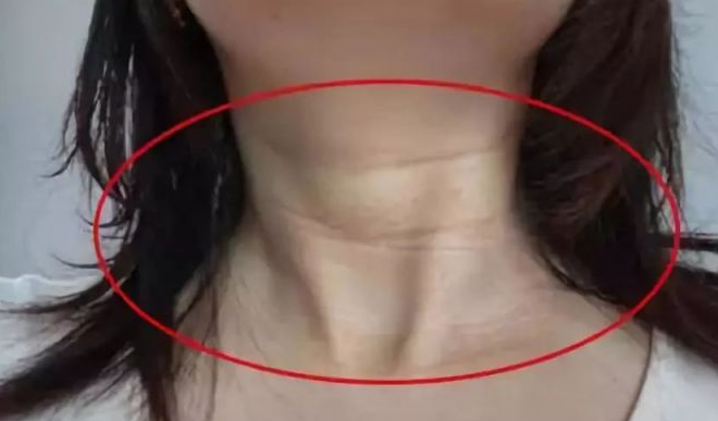 颈纹像年轮？丑哭！抹掉颈纹你需要它——超级微拉美752