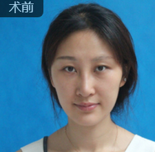 去眼袋手术