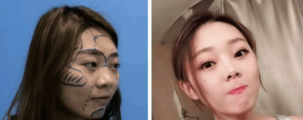 自体脂肪填充术→春节过后献给自己最好的礼物！275