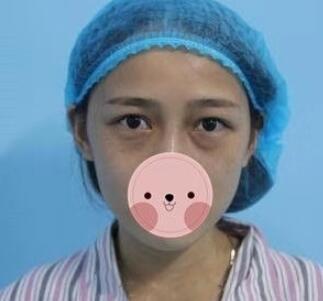 为您揭秘超声波去眼袋126 为您揭秘超声波去眼袋126