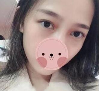 为您揭秘超声波去眼袋126 为您揭秘超声波去眼袋126