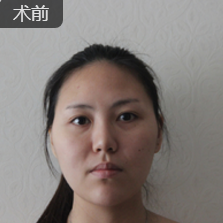 重庆超雅面部提升术让我不再为自己的颜值发愁！840