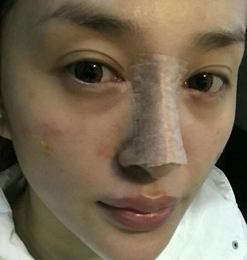 隆鼻手术后美不美?真实案例说了算761 隆鼻手术后美不美?真实案例说了算761