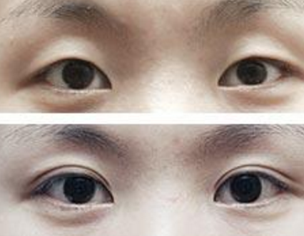 超 声 波双眼 皮手术让wǒ变得更美le，更俏丽le！