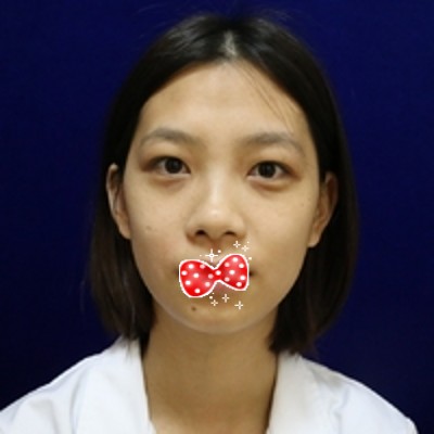 完美去掉眼袋不反弹,超声波去眼袋087 完美去掉眼袋不反弹,超声波去眼袋087