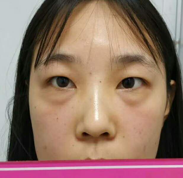 超 声 波去眼袋手术,清洁眼袋好轻松得! 超 声 波去眼袋手术,清洁眼袋好轻松得!