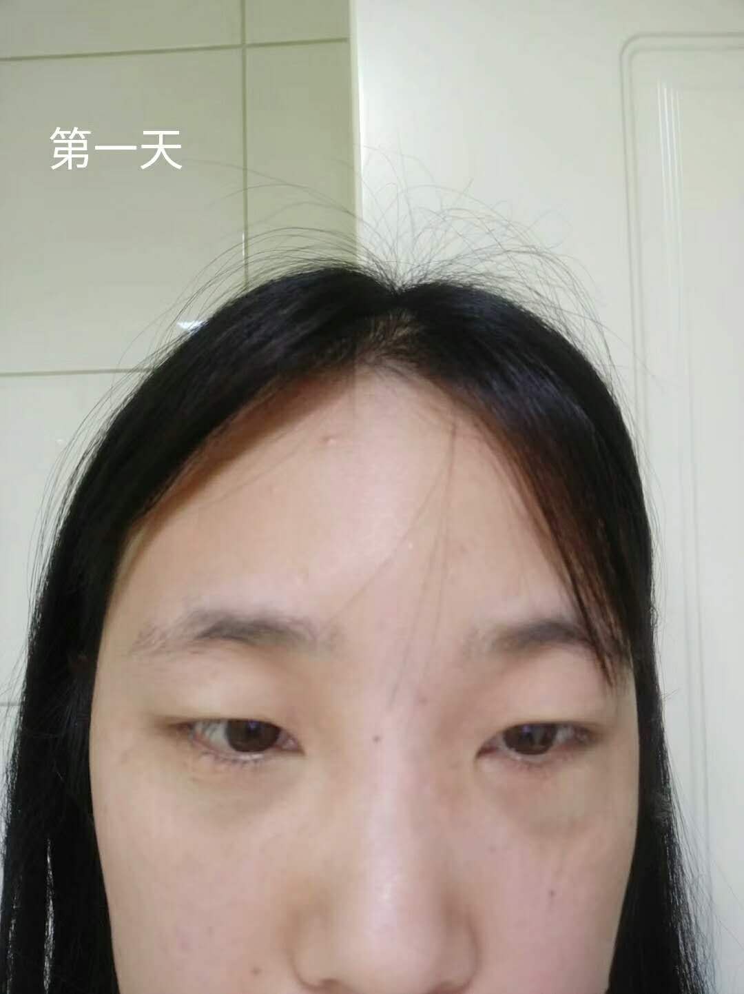 超 声 波去眼袋手术,清洁眼袋好轻松得! 超 声 波去眼袋手术,清洁眼袋好轻松得!