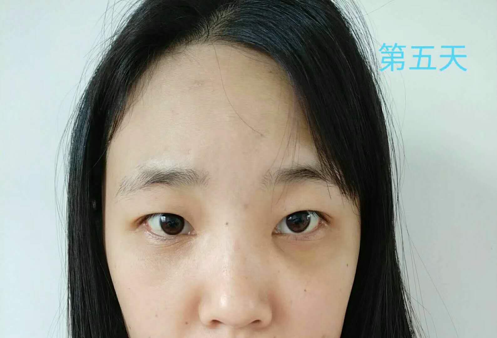 超 声 波去眼袋手术,清洁眼袋好轻松得! 超 声 波去眼袋手术,清洁眼袋好轻松得!