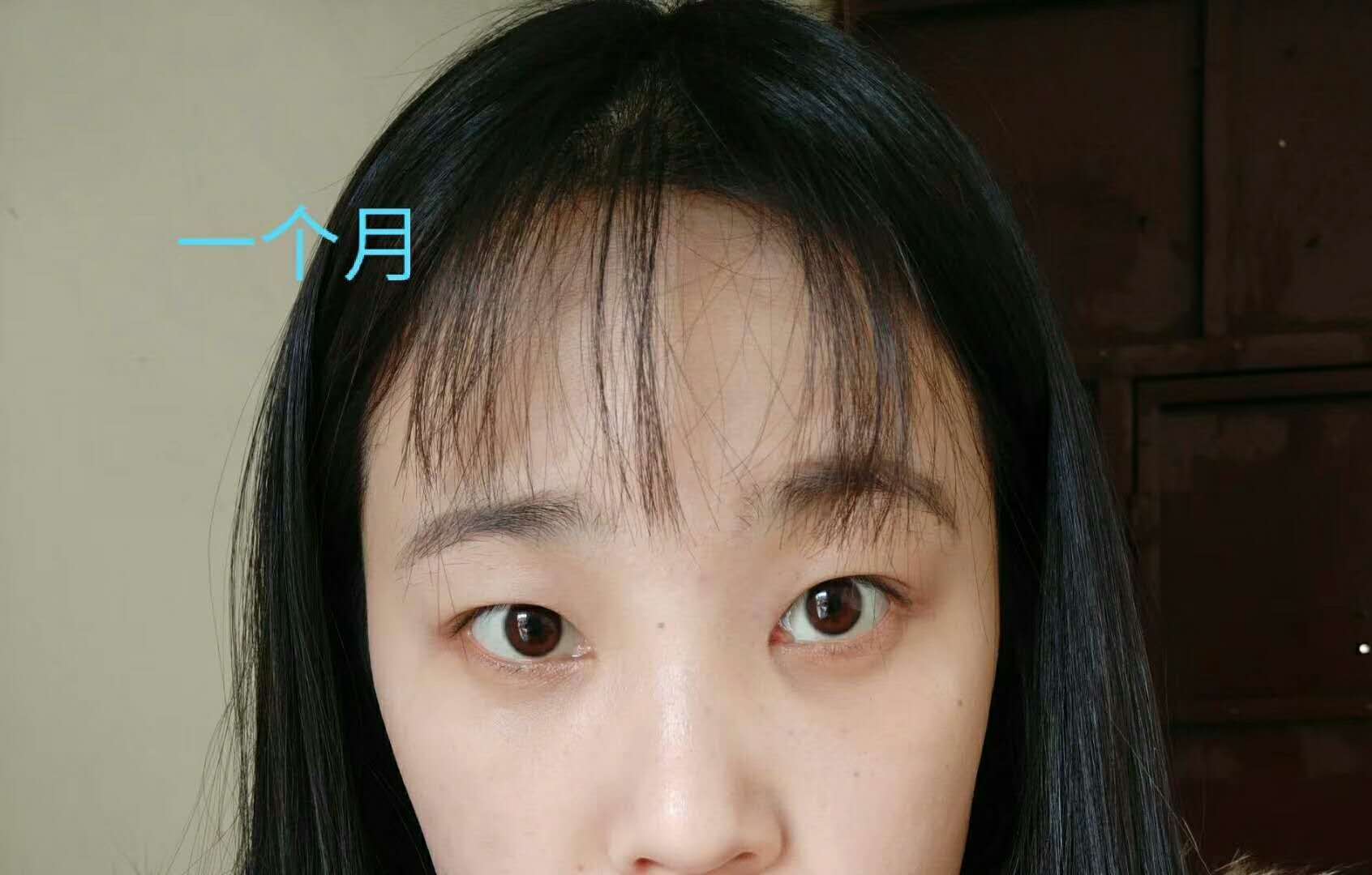 超 声 波去眼袋手术,清洁眼袋好轻松得! 超 声 波去眼袋手术,清洁眼袋好轻松得!