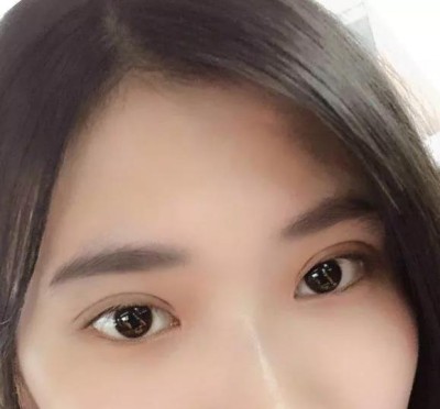大学生的我,做双眼皮后美丽的蜕变!078 大学生的我,做双眼皮后美丽的蜕变!078