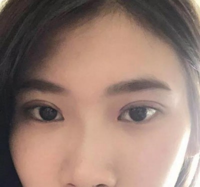 大学生的我,做双眼皮后美丽的蜕变!078 大学生的我,做双眼皮后美丽的蜕变!078