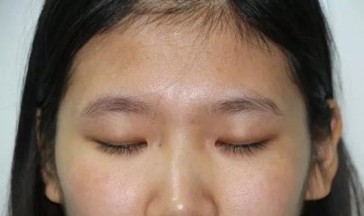 大学生的我,做双眼皮后美丽的蜕变!078 大学生的我,做双眼皮后美丽的蜕变!078