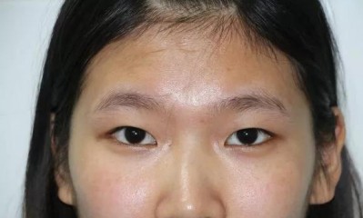 大学生的我,做双眼皮后美丽的蜕变!078 大学生的我,做双眼皮后美丽的蜕变!078