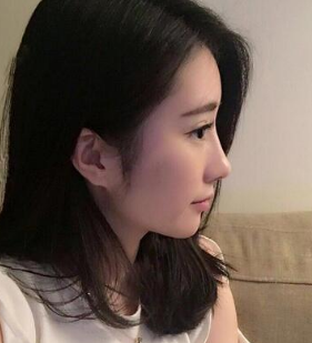 那个做过超声波双眼皮手术的女孩，现在怎么样了？035
