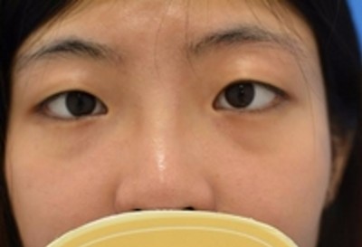 我的不老秘诀,超声波去眼袋427 我的不老秘诀,超声波去眼袋427