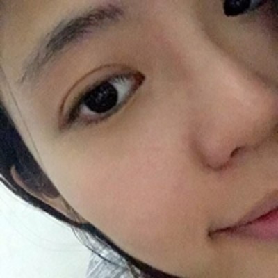 我的不老秘诀,超声波去眼袋427 我的不老秘诀,超声波去眼袋427