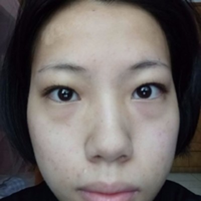 能够保证眼袋不再复发得去眼袋,超声波去眼袋864 能够保证眼袋不再复发得去眼袋,超声波去眼袋864