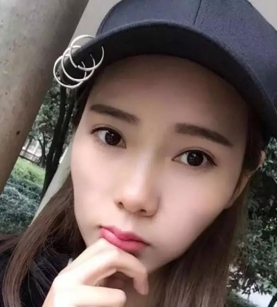 超声波双眼皮修复了我的双眼皮!360 超声波双眼皮修复了我的双眼皮!360