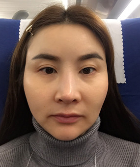 重庆超雅面部提升术让颓废大嫂晋级氧气美女634 重庆超雅面部提升术让颓废大嫂晋级氧气美女634
