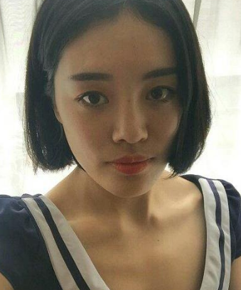 重庆超雅自体脂肪填充术让你拥有少女该有的容颜502