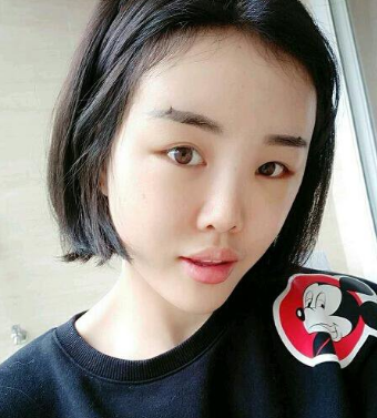 重庆超雅自体脂肪填充术让你拥有少女该有的容颜502