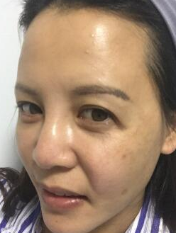 面部提升术让年轻喜从天降105 面部提升术让年轻喜从天降105