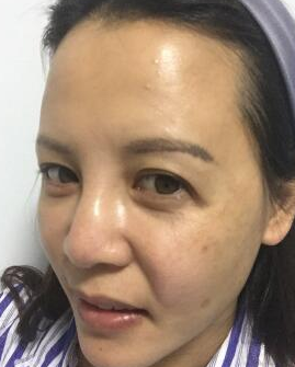 重庆超雅面部提升术效果看得见,年轻看得见!865 重庆超雅面部提升术效果看得见,年轻看得见!865