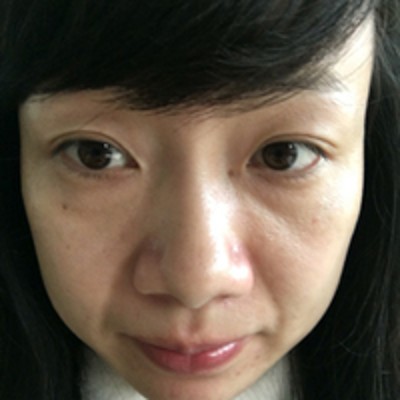 超 声 波去眼袋手术去掉眼袋简直太轻松le 超 声 波去眼袋手术去掉眼袋简直太轻松le