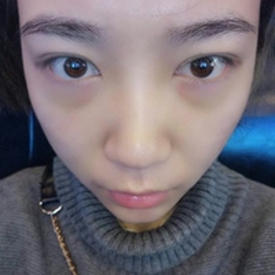 绝佳的去眼袋方法,超声波去眼袋705 绝佳的去眼袋方法,超声波去眼袋705