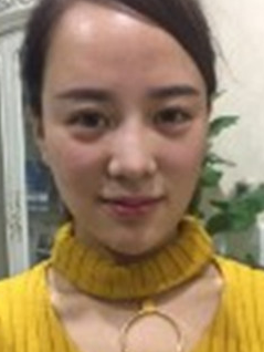 要问拿什么拯救青春?当然是面部提升术了!551 要问拿什么拯救青春?当然是面部提升术了!551