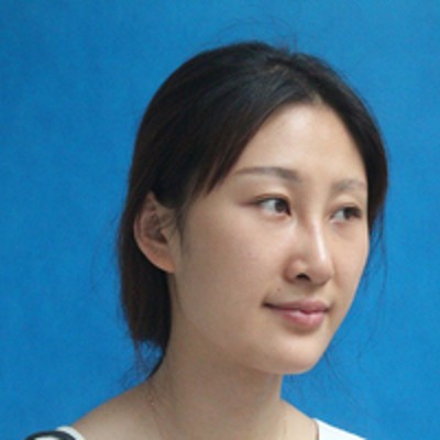 超声波去眼袋前后对比下,差距真的蛮大的188 超声波去眼袋前后对比下,差距真的蛮大的188