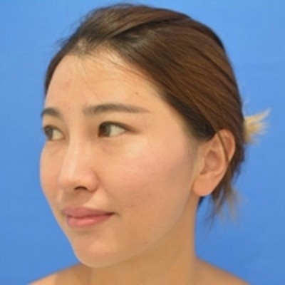 超声波去眼袋,再也不为眼袋的事情发愁了672 超声波去眼袋,再也不为眼袋的事情发愁了672