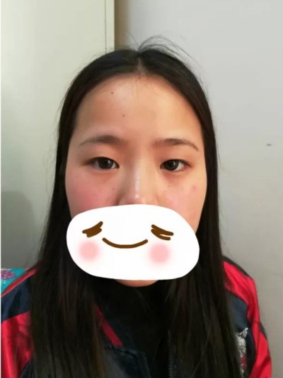 怎样做双眼皮才不会痛？超声波双眼皮，无痛的双眼皮787