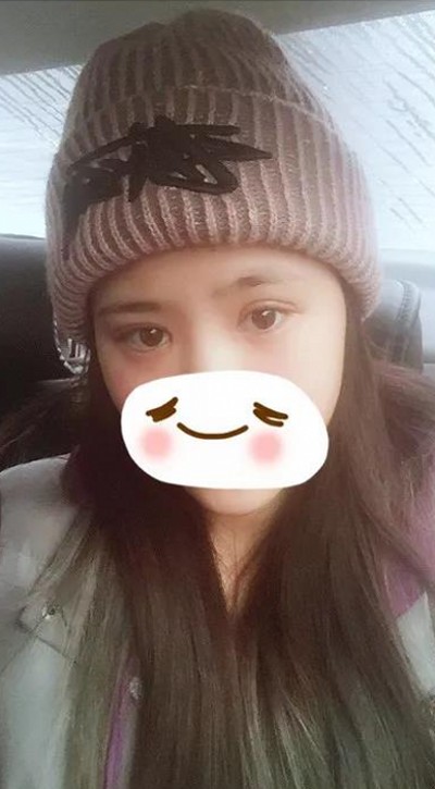 怎样做双眼皮才不会痛？超声波双眼皮，无痛的双眼皮787