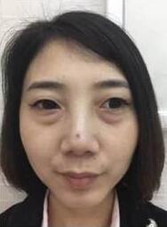超声波去眼袋还是好啊539 超声波去眼袋还是好啊539