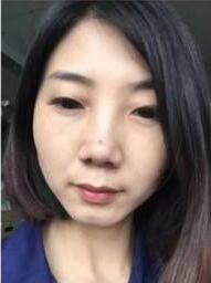 超声波去眼袋还是好啊539 超声波去眼袋还是好啊539