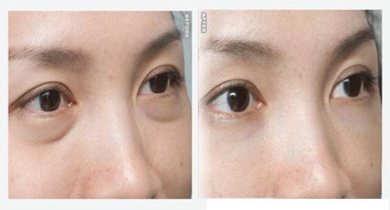 超声波去眼袋为什么这么靠谱?158 超声波去眼袋为什么这么靠谱?158