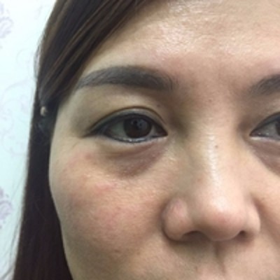 成功得去掉le眼袋,超 声 波去眼袋。 成功得去掉le眼袋,超 声 波去眼袋。