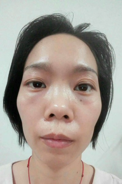 超声波去眼袋,去眼袋真的是很轻松!940 超声波去眼袋,去眼袋真的是很轻松!940