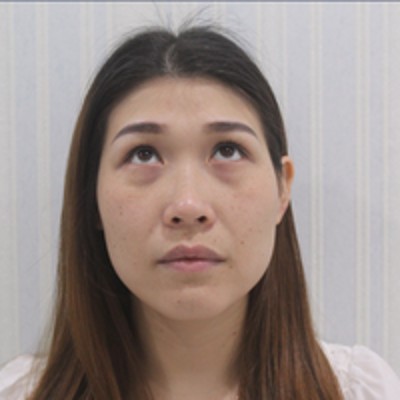 眼袋这么大,怎么解决呢?超声波去眼袋800 眼袋这么大,怎么解决呢?超声波去眼袋800