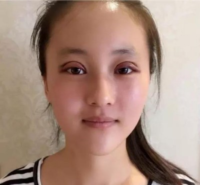 怎么做双眼皮最安全?超声波双眼皮。658 怎么做双眼皮最安全?超声波双眼皮。658