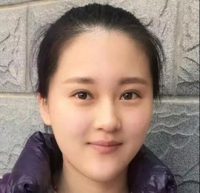 怎么做双眼皮最安全?超声波双眼皮。658 怎么做双眼皮最安全?超声波双眼皮。658