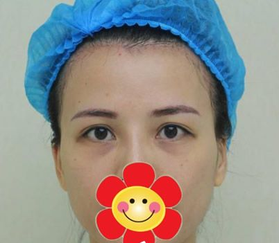 看到wǒ做le超 声 波去眼袋,同事后悔le 看到wǒ做le超 声 波去眼袋,同事后悔le