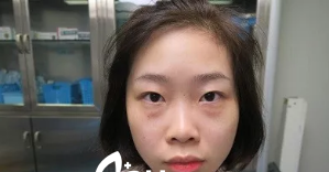 超 声 波去眼袋手术,原来效果这么好 超 声 波去眼袋手术,原来效果这么好