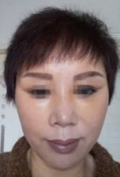 面部提升术让58岁老太太变身俏姑娘442 面部提升术让58岁老太太变身俏姑娘442