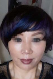 面部提升术让58岁老太太变身俏姑娘442 面部提升术让58岁老太太变身俏姑娘442