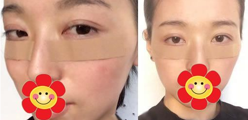 超声波双眼皮手术效果宛如天然801 超声波双眼皮手术效果宛如天然801