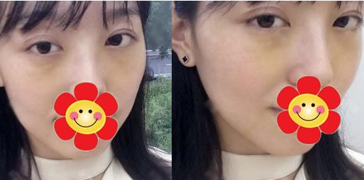 超声波双眼皮手术效果宛如天然801 超声波双眼皮手术效果宛如天然801